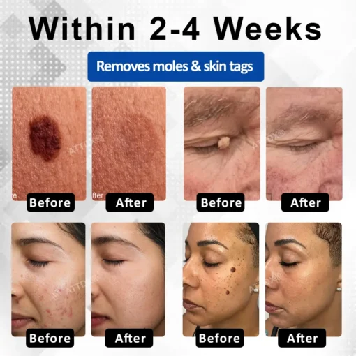 RICPIND® DermaLite Mole and Wart Removal Laser Pen