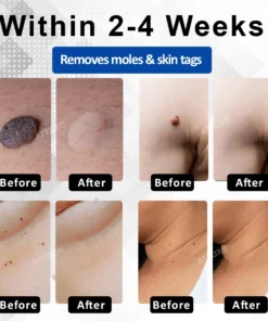 RICPIND® DermaLite Mole and Wart Removal Laser Pen
