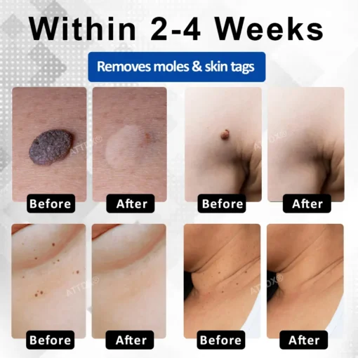 RICPIND® DermaLite Mole and Wart Removal Laser Pen