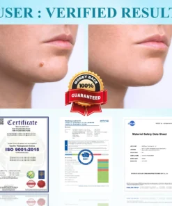 RICPIND® DermaLite Mole and Wart Removal Laser Pen