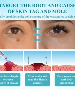 RICPIND® DermaLite Mole and Wart Removal Laser Pen