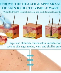 RICPIND® DermaLite Mole and Wart Removal Laser Pen