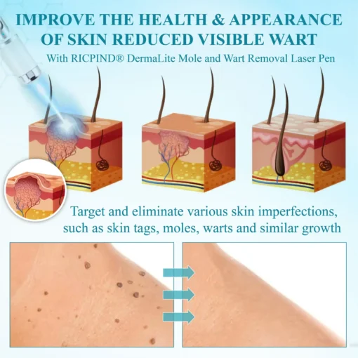 RICPIND® DermaLite Mole and Wart Removal Laser Pen