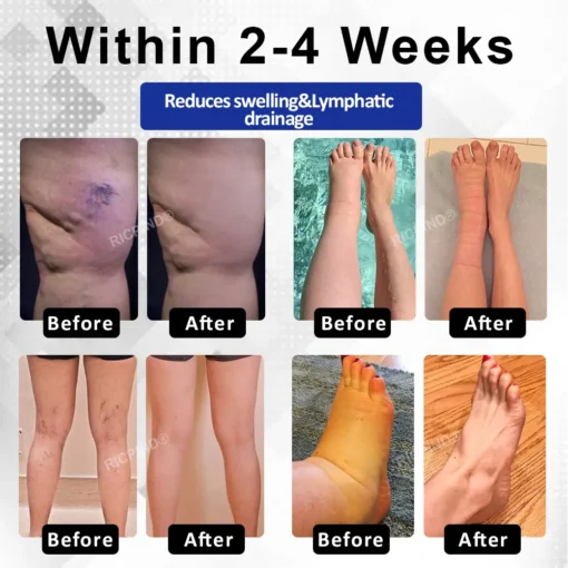 RICPIND® VenoLight Edema Relief TENS Pen