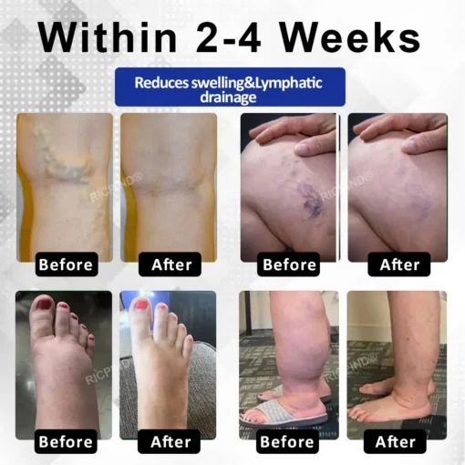 RICPIND® VenoLight Edema Relief TENS Pen