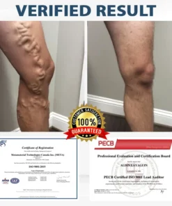 RICPIND® VenoLight Edema Relief TENS Pen