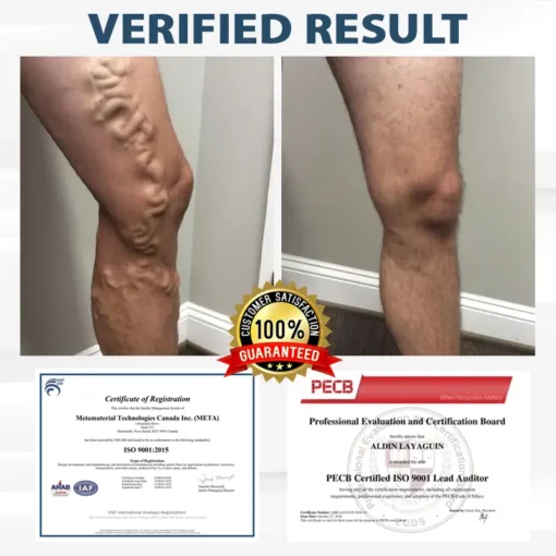 RICPIND® VenoLight Edema Relief TENS Pen