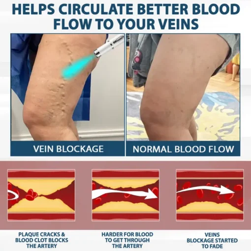 RICPIND® VenoLight Edema Relief TENS Pen