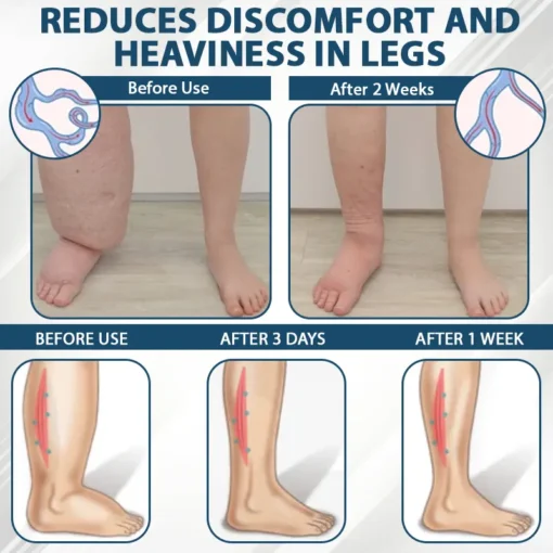 RICPIND® VenoLight Edema Relief TENS Pen