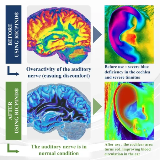 RICPIND® Tinnitus EchoBalance Modulator
